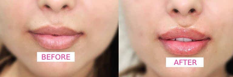 DC-lip-filler-1